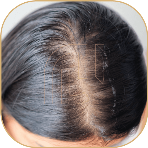 Tratamento de calvície (Alopecia androgenética)